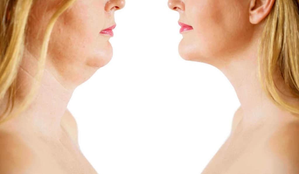 Double Chin treatment White City before and after results