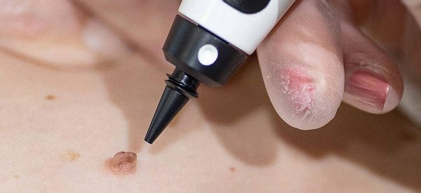 After Skin Tag Removal White City