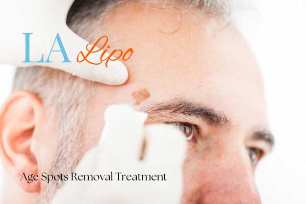 What Are the Most Effective Treatments for Age Spots White City?