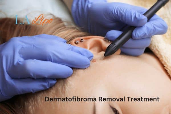 Dermatofibroma Removal Treatment White City