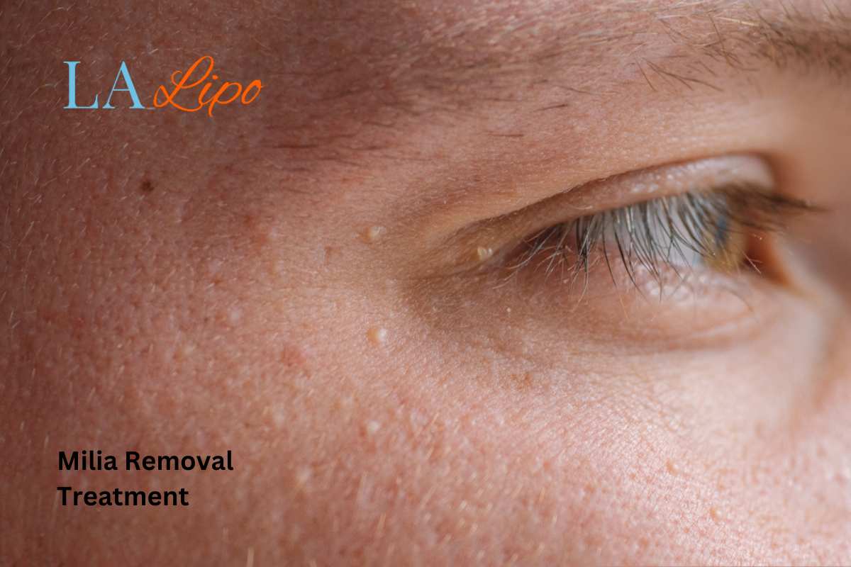 Cryopen Milia Removal: Is It the Easiest and Safest Option White City?
