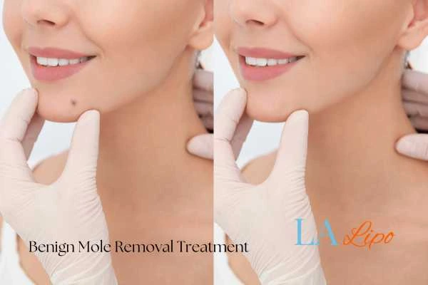Before-and-after results following benign mole-removal treatment White City