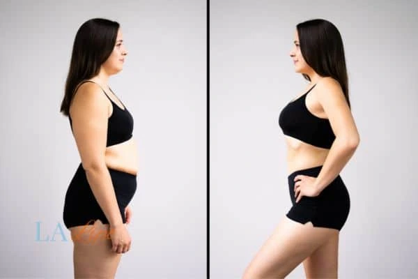 image of woman before and after results of LA-EMS Body Sculpting White City to help treat Diastasis recti