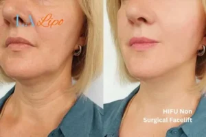 hi-fu for wrinkles White City before and after results