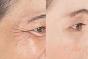 Before and after results of woman - HI-fu wrinkles reduction treatment White City