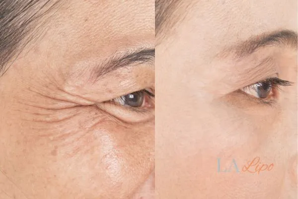 Before and after results of woman - HI-fu wrinkles reduction treatment White City