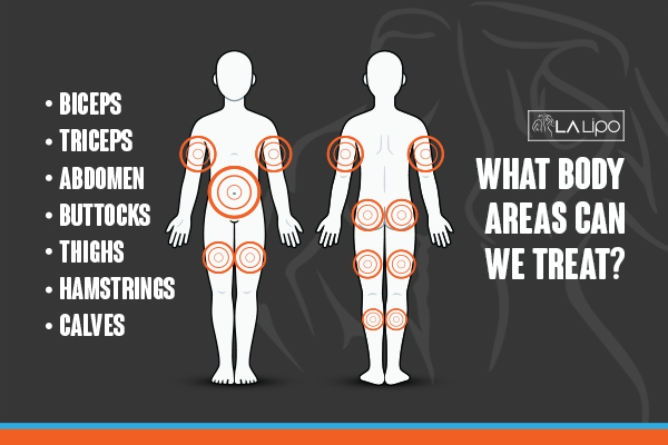 Graphic to show areas you can have LA-EMS Body Sculpting White City treatment.