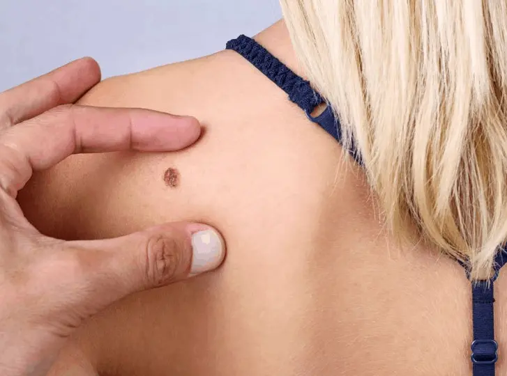 woman having mole removal White City consultation before treatment.