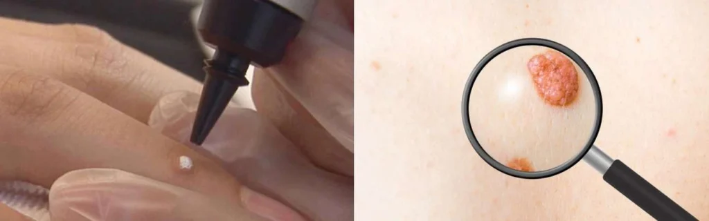 CryoPen practitioner White City assessing a benign mole before treatment
