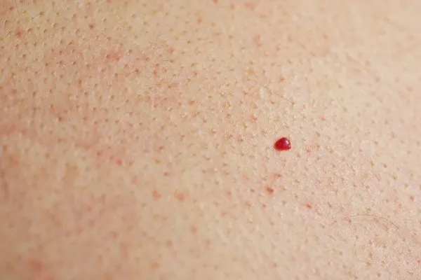 close up of a cherry angioma White City