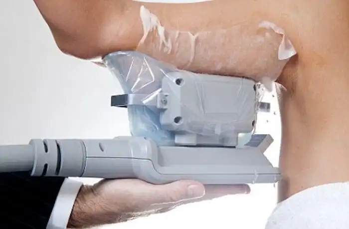 Picture of fat freezing White City on the upper arms.