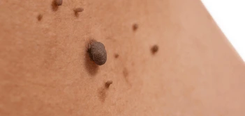 image of a skin tag White City