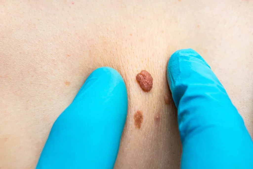 Consultant examining a skin tag White City