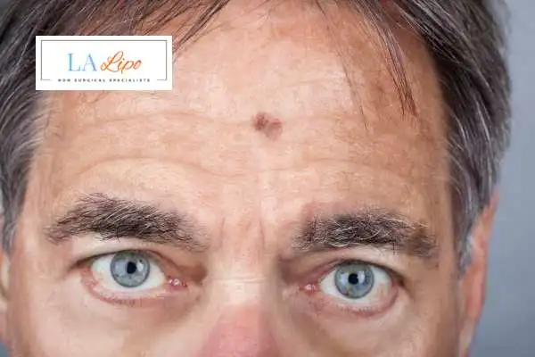 Solar Lentigo Removal White City image of man with mark on his forehead