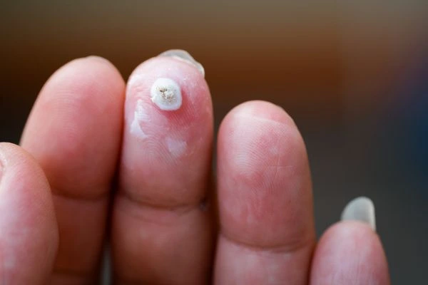 wart on person finger - cryotherapy to treat from LA LIPO White City