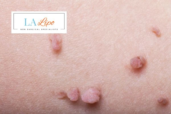 Does cryopen skin tag removal White City hurt? Find out now call our team today!