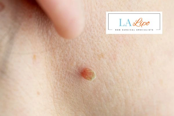 Book skin tag removal White City today speak to our team now!