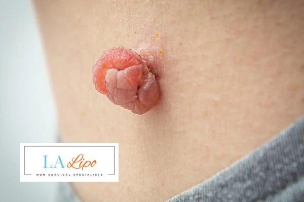 Interested in skin tag removal White City? Concerned about the pain? Find out more today!