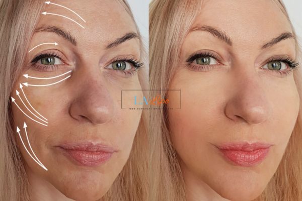 Morpheus 8 results White City face lift.