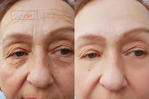 The powerful benefits of Morpheus8 Treatment White City - Call Our team today!
