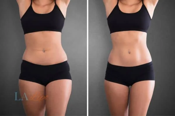 before and after results of non-surgical treatment to help a woman's body image and mental health White City