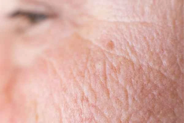 close up picture of a woman's face showing an age spot White City