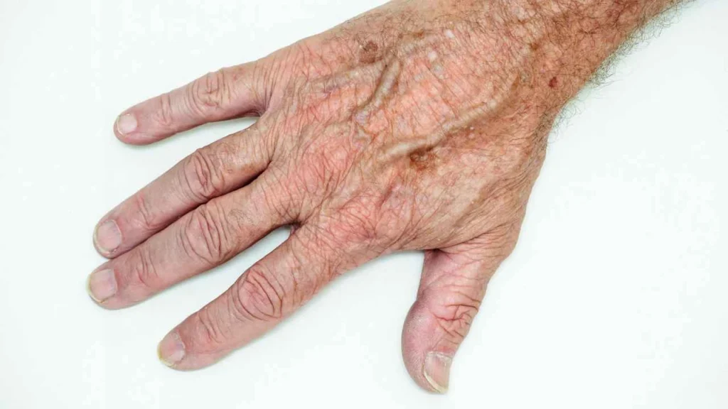 Male hand showing age spot White City