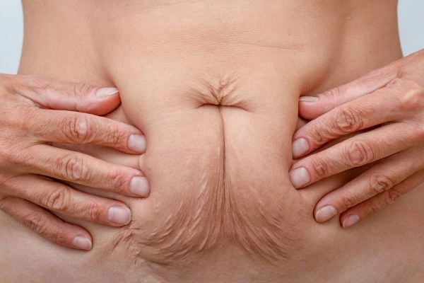 Image of a woman's stomach with loose skin - example of skin tightening White City options