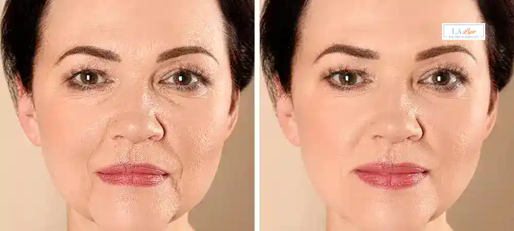 How Long Does It Take to See Results and How Long Do They Last White City?