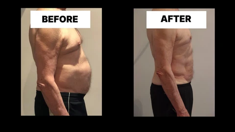 What Symptoms Can Diastasis Recti Cause in Men? Weak Core, Back Pain and Poor Posture White City